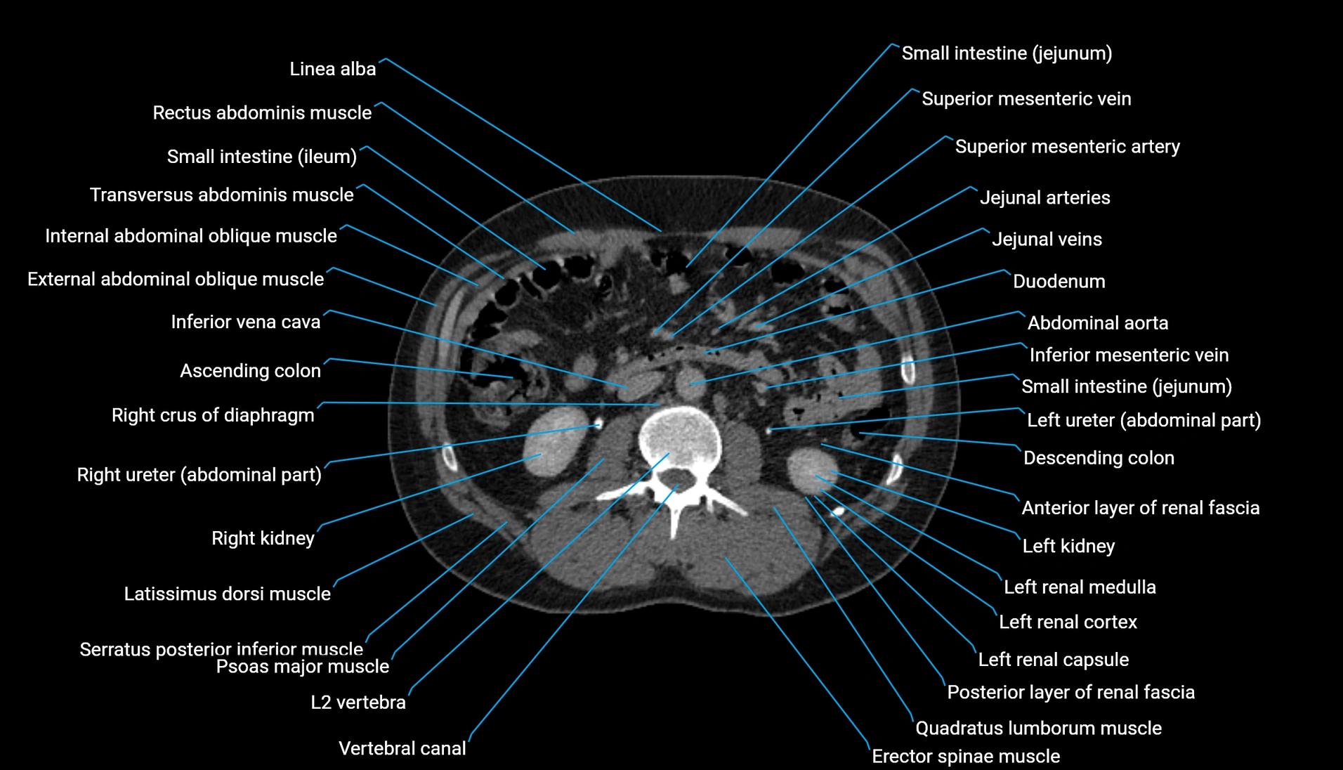 CT urogram axial cross sectional anatomy  labelled radiology image-00118.webp